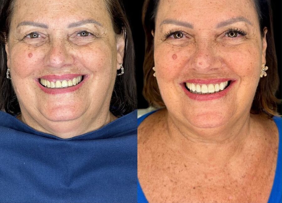 Caso de transformação do sorriso — antes e depois