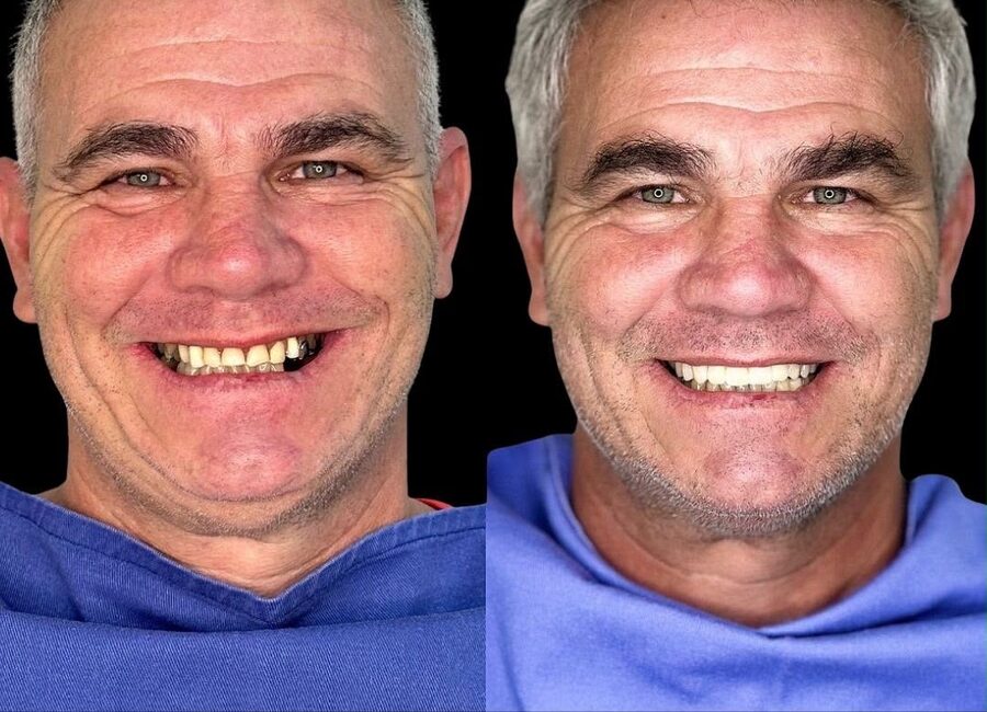 Caso de reabilitação oral com implantes — antes e depois