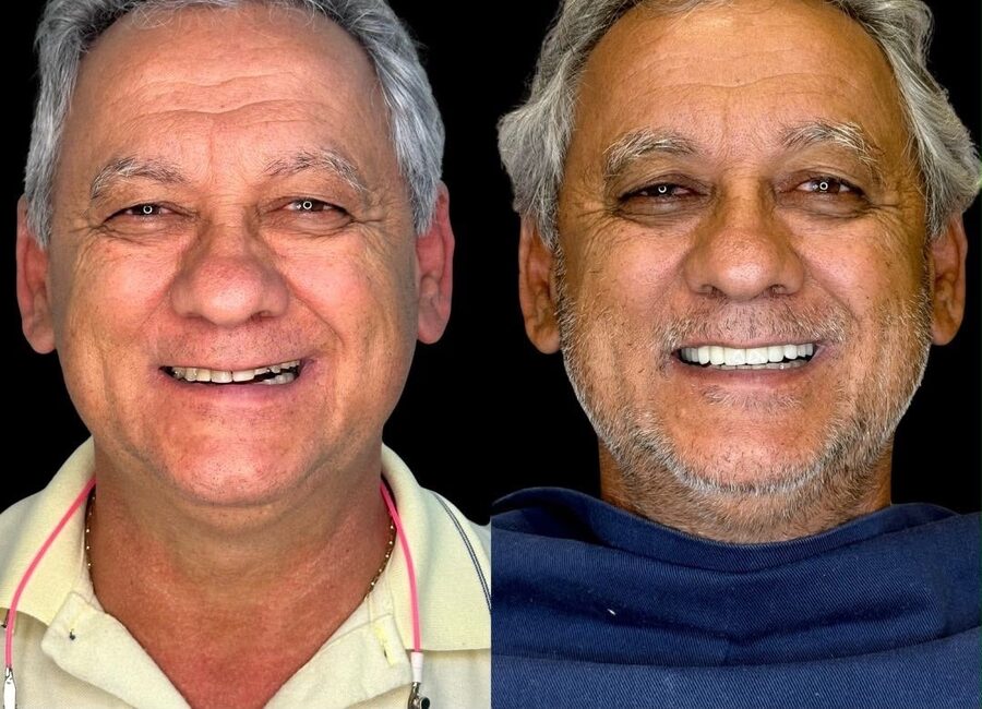 Caso de prótese fixa — antes e depois