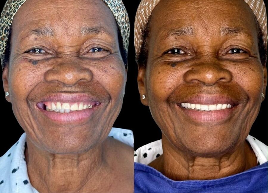 Caso de harmonização do sorriso — antes e depois