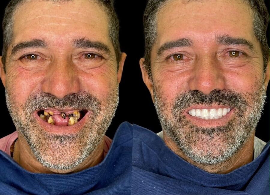 Caso de reabilitação oral completa — antes e depois